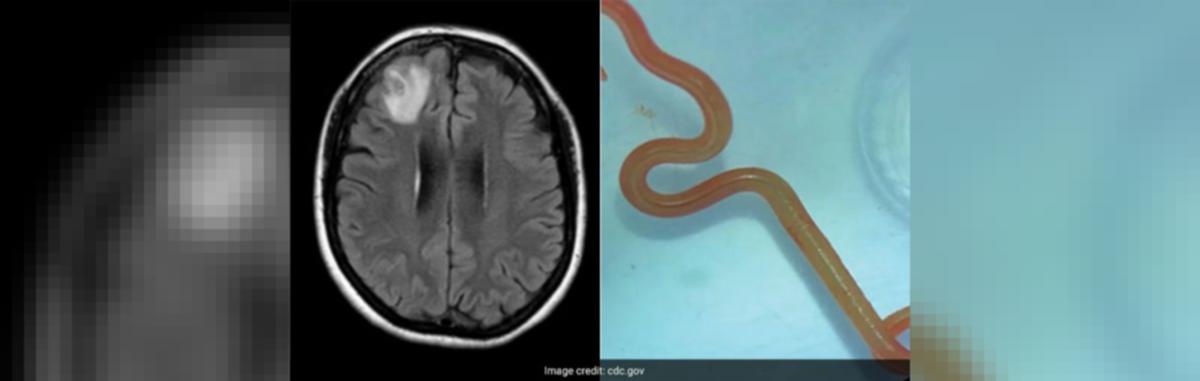 Neurosurgeon plucks 'live' parasitic worm from woman's brain in Australia