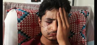 Both of 16-year-old Tanveer's eyes have been damaged. Photo: Mudasir Ahmad