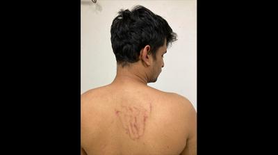 Injuries on Penkar's back after the assault. Photo: Twitter/@caravanindia