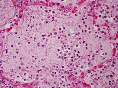 Representative image of alveoli filled with edema fluid as well as fibrin strands. Photo: Dr. Yale Rosen Atlas of Pulmonary Pathology/Flickr (CC BY-SA 2.0 DEED)